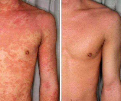Eczema Relief Cream with Aloe Vera Oats Soothing Skin Moisturizer
