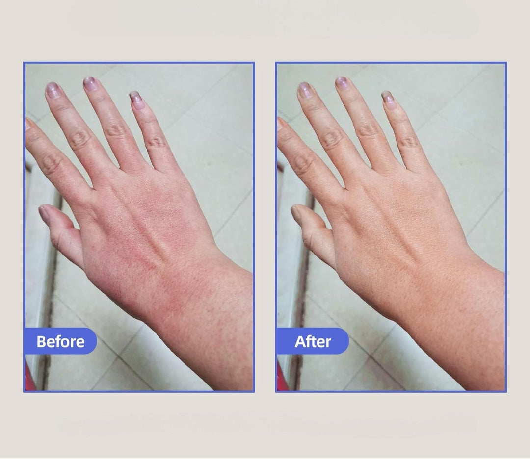 Eczema Relief Cream with Aloe Vera Oats Soothing Skin Moisturizer
