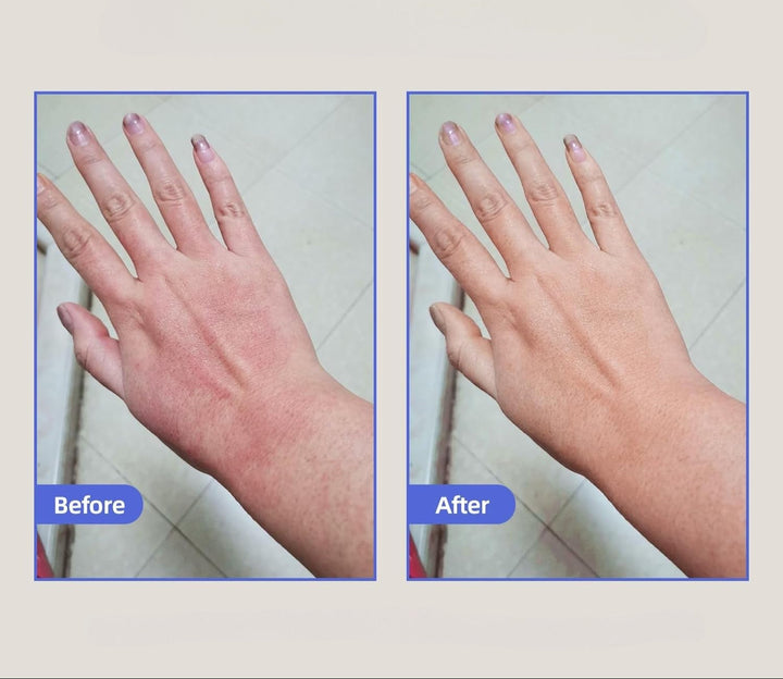 Eczema Relief Cream with Aloe Vera Oats Soothing Skin Moisturizer