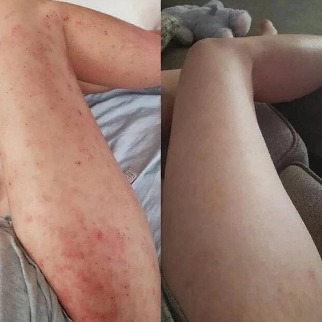 Eczema Relief Cream with Aloe Vera Oats Soothing Skin Moisturizer