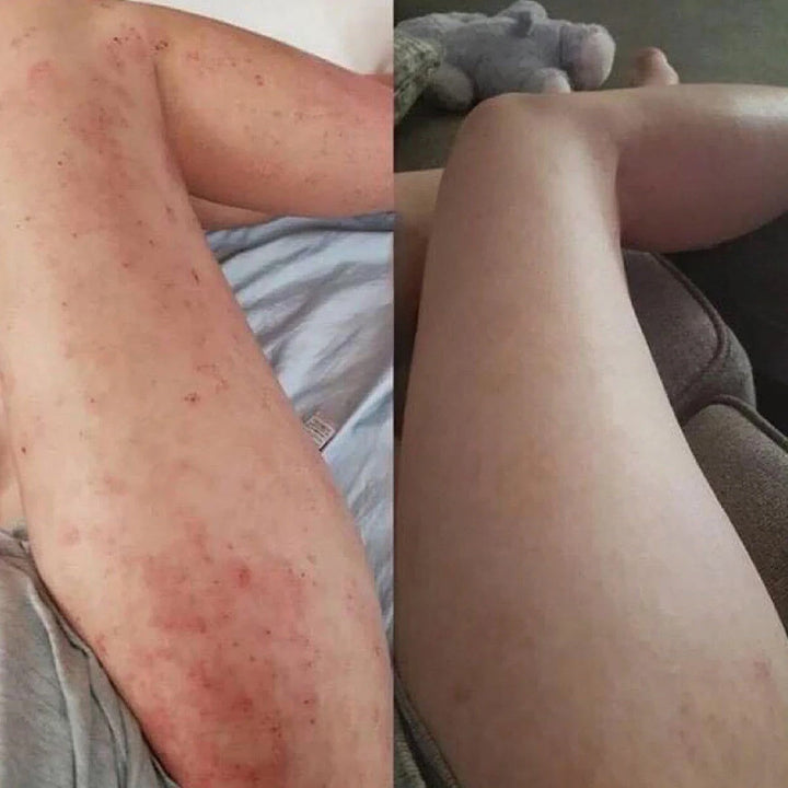 Eczema Relief Cream with Aloe Vera Oats Soothing Skin Moisturizer